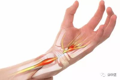 「警惕」手指麻痛，小心是腕管综合征！佛中医腕管镜微创治顽疾