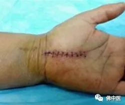 「警惕」手指麻痛，小心是腕管综合征！佛中医腕管镜微创治顽疾