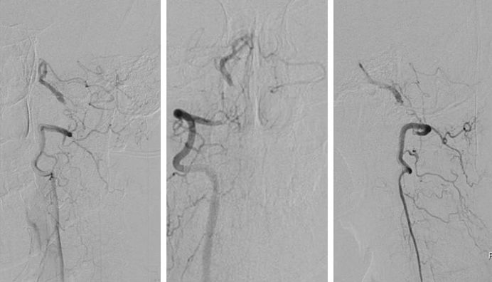椎动脉起始段狭窄的介入治疗ppt,椎动脉v4段假性动脉瘤介入治疗