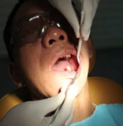 哪十家医院种植牙享受补贴,缺牙市民可申请免费种牙