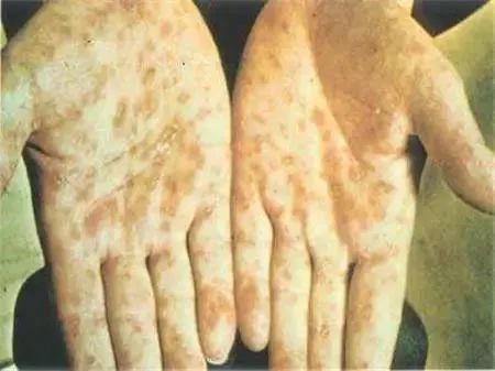 男子发现梅毒潜伏20年,男子身患梅毒