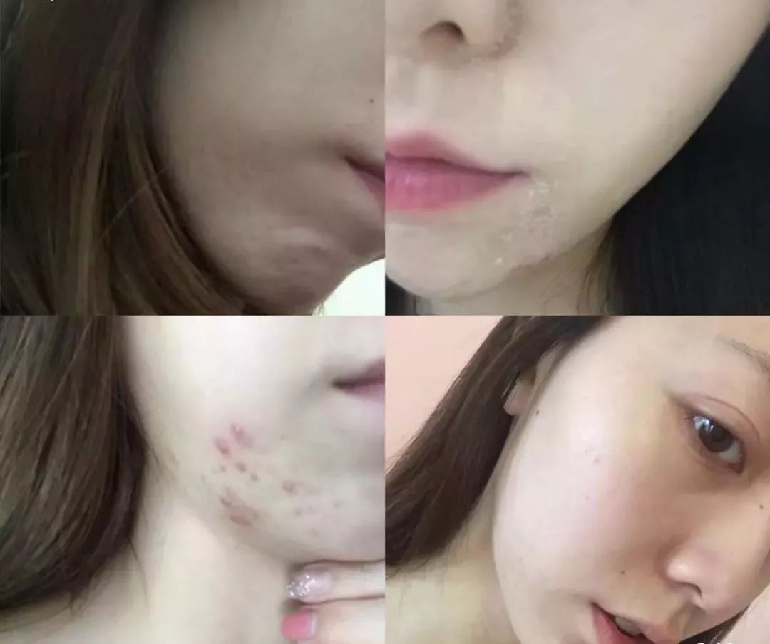 红肿，流脓的万年毒痘一喷全消失？岛国新晋痘肌终结者！彻底祛痘不反复！