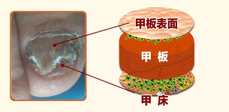 十年灰指甲可以治好吗,一次搞定顽固灰指甲