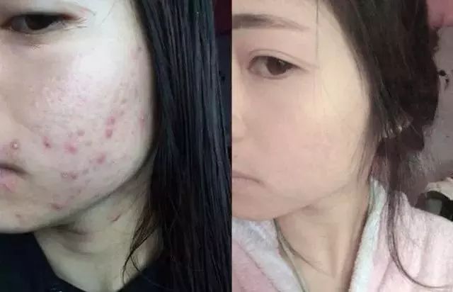 人脸上螨虫的数量,人脸上有多少螨虫