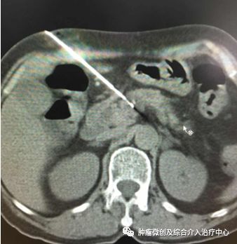胰腺癌碘125粒子治疗术几天出院,胰腺癌晚期适合碘125粒子植入吗