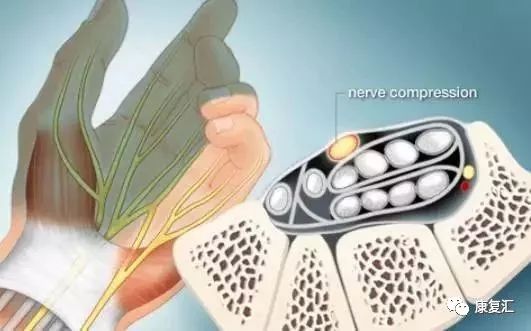 鼠标手康复科普文章,鼠标手的康复和治疗