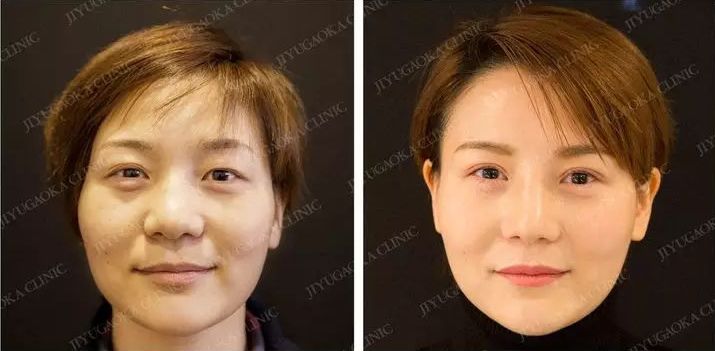 强势围观！日本最牛的一家整形医院，募集中国模特啦啦啦~