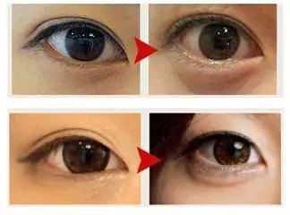 玻尿酸填充是个无底洞吗,玻尿酸是不是无底洞