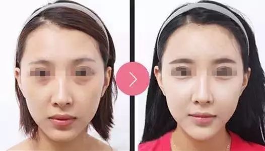 玻尿酸填充是个无底洞吗,玻尿酸是不是无底洞