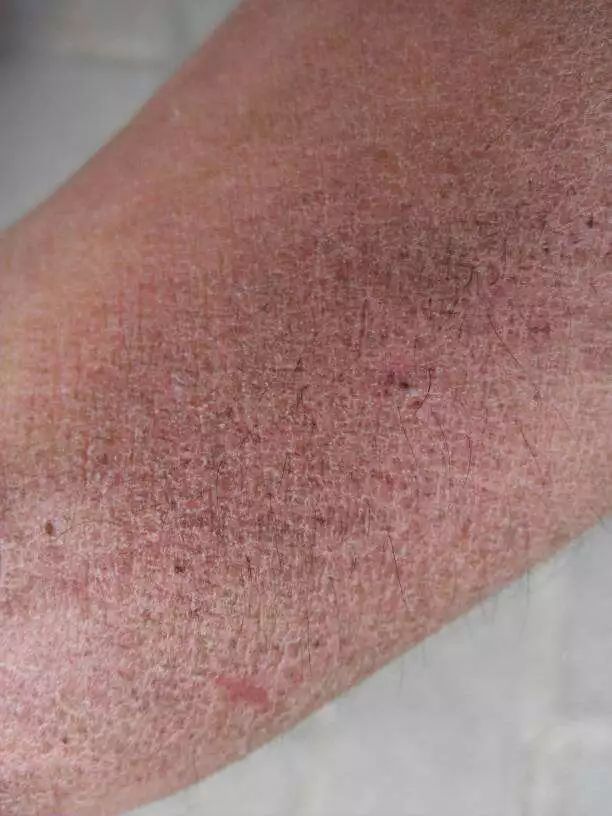 什么症状要看风湿免疫科,风湿免疫性疾病有哪些症状