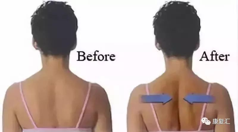 高低肩怎么快速纠正改善,严重高低肩怎么自我矫正