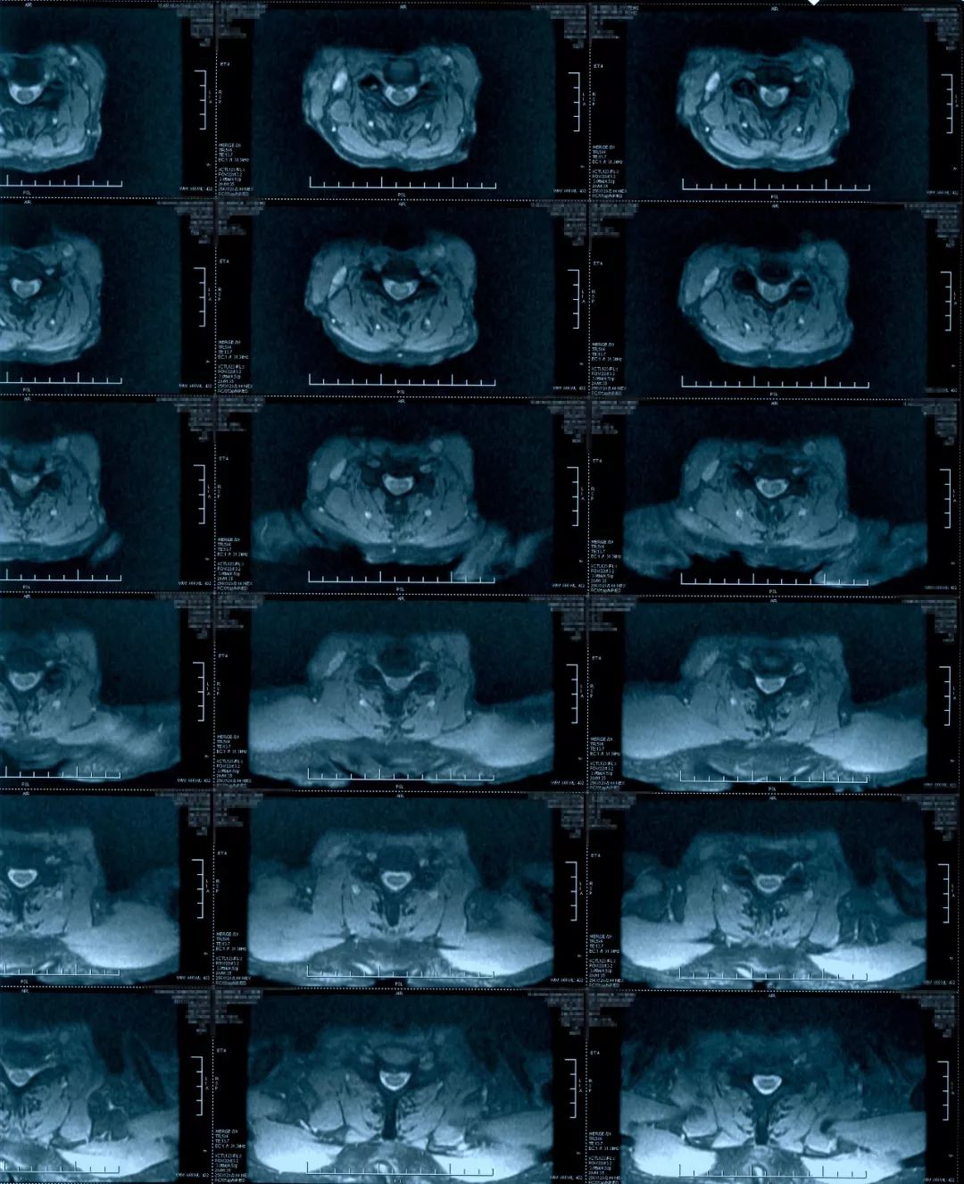 椎管狭窄水肿最佳治疗方法,椎管水肿如何治疗