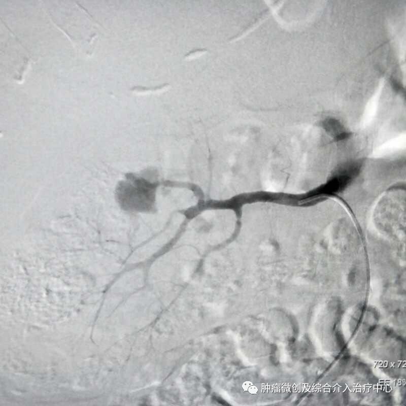 运城市第一医院肿瘤科咋样,运城第一医院治疗肿瘤怎么样