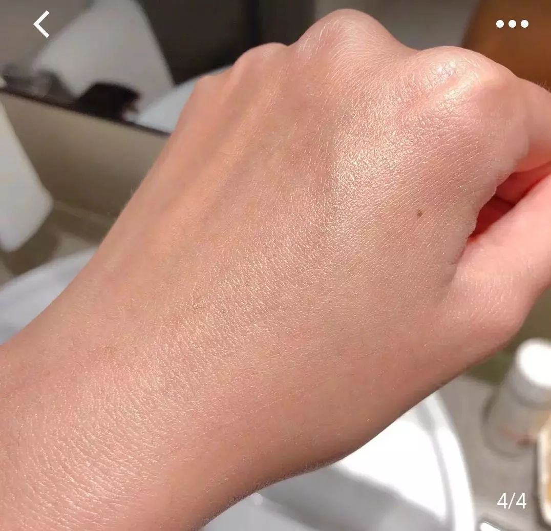 脱发算啥!90后已经开始长“老年斑”了,有人还为此花了10多万!