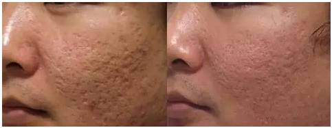 激光美容祛疤的真实性,激光美容真的靠谱吗