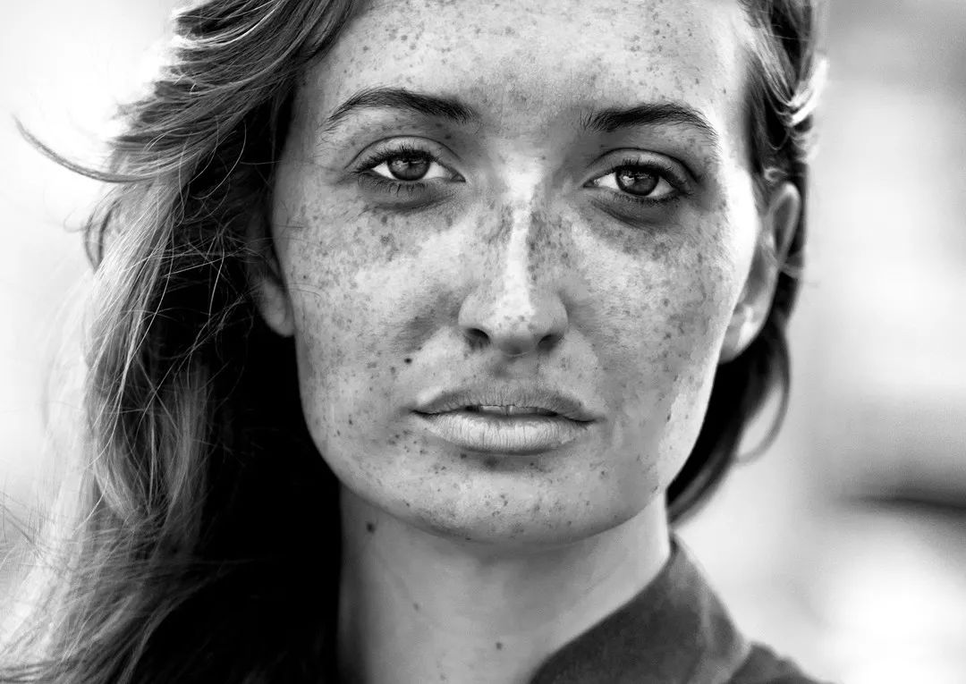 褐斑能彻底去除吗,褐斑到底是治得好还是治不好