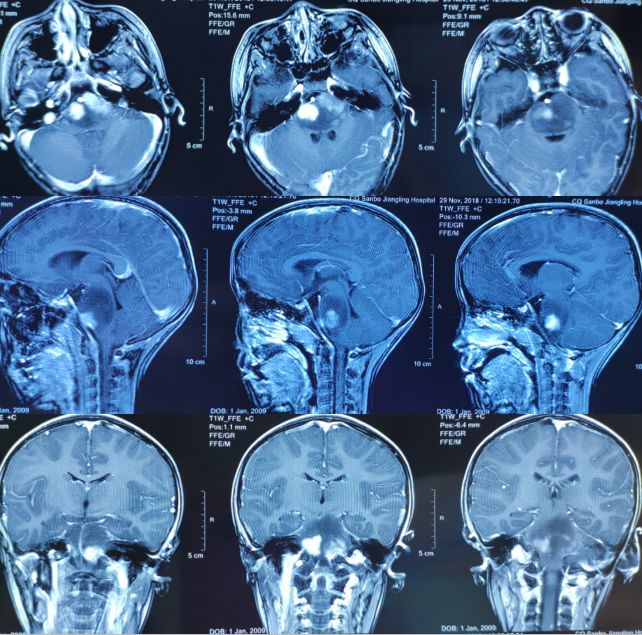 赞！重庆三博江陵医院成功开展脑干占位立体定向活检术！