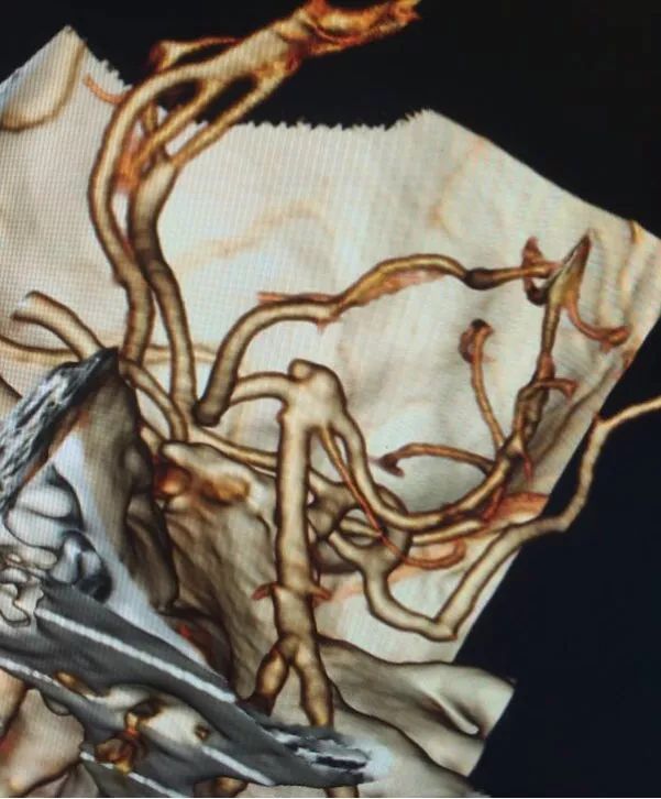 柳暗花明专栏|栓塞颅内动脉瘤时微导管无法穿过LVIS支架网眼怎么办