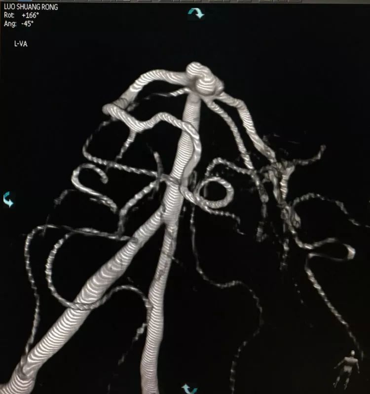 柳暗花明专栏|栓塞颅内动脉瘤时微导管无法穿过LVIS支架网眼怎么办