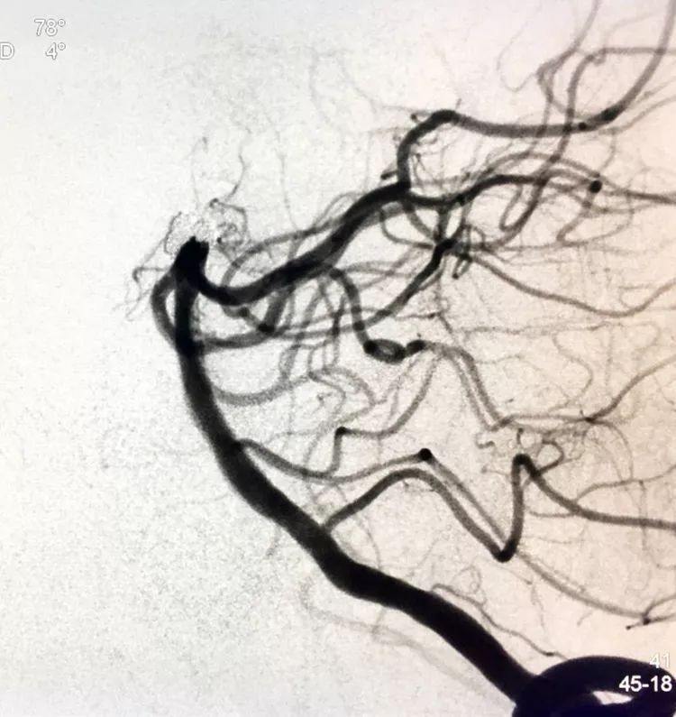 柳暗花明专栏|栓塞颅内动脉瘤时微导管无法穿过LVIS支架网眼怎么办