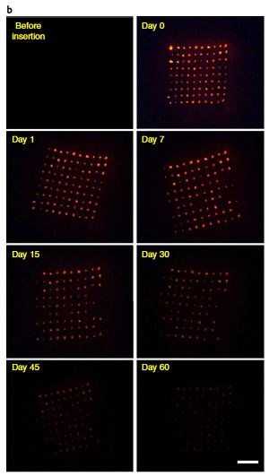 避孕帽避孕贴片,避孕贴片一片能避孕多久