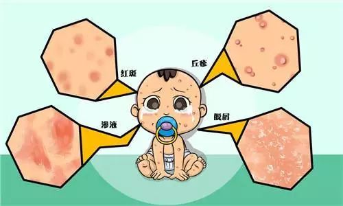 幼儿湿疹最佳治疗方法,育儿知识婴儿湿疹