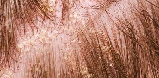 头皮屑洗不掉怎么办有什么方法,头发头皮屑多且大块还结痂有虫