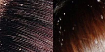 头上头皮屑和剪发虫怎么解决,头皮屑多且大块还结痂会不会有虫