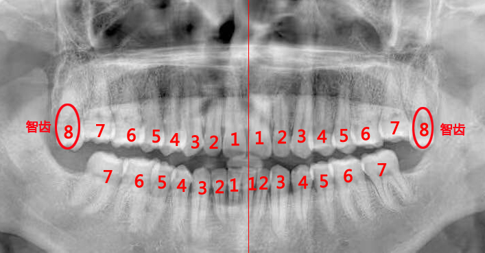 智齿发炎可以不拔吗,智齿都拔了牙龈还发炎怎么办