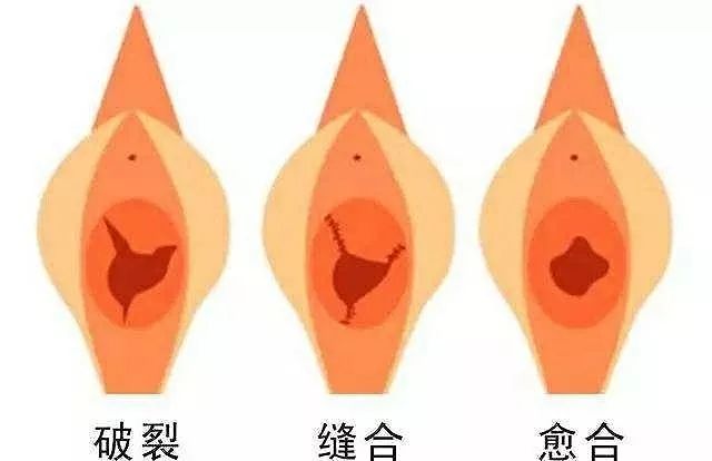 「女科荟」大部分人都错了——处女膜其实不是膜！
