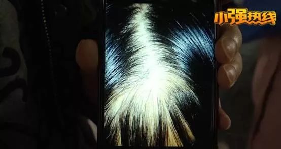 头发睫毛眉毛全部掉光能不能治好,头发睫毛眉毛全部掉光有没有案例