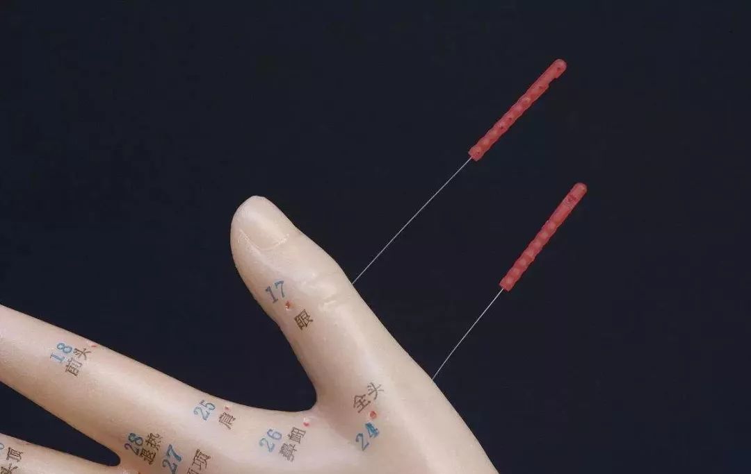 针灸能缓解更年期症状吗?