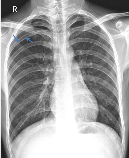 气胸的x线表现胸膜炎,胸外科气胸病人病例