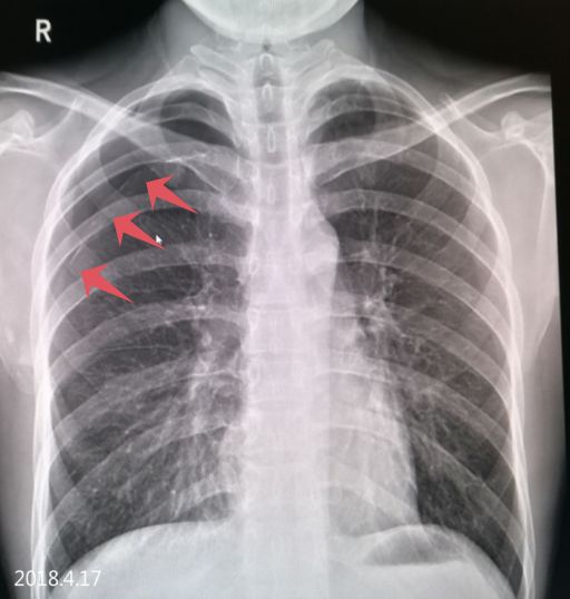 气胸的x线表现胸膜炎,胸外科气胸病人病例