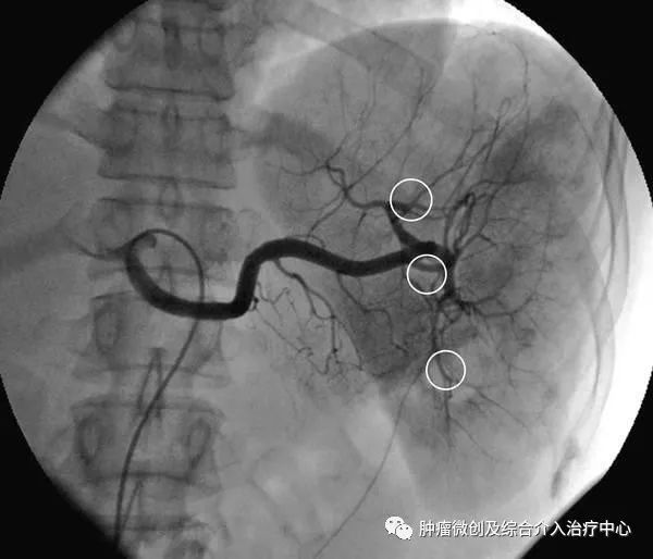 脾动脉栓塞术,脾栓塞手术的适应症