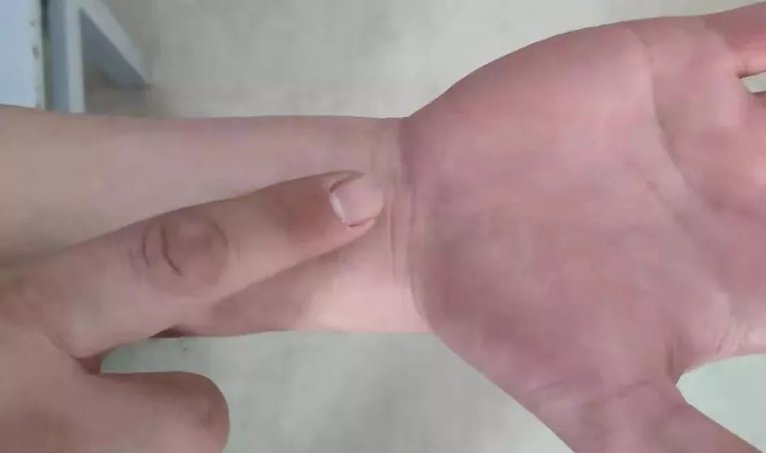 怎样帮中风的人做康复训练视频,如何解决中风后遗症问题