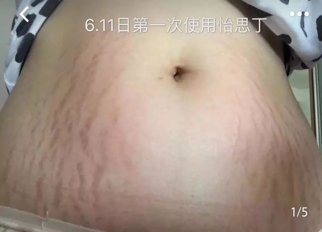 疤痕体质如何去痘印和烫伤印,烫伤色素疤痕修复的最新方法