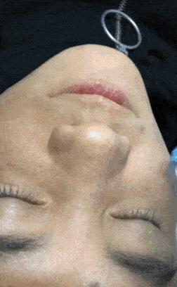 辣眼睛，有人用它吸出一整年的黑头，看完我果断下单了！