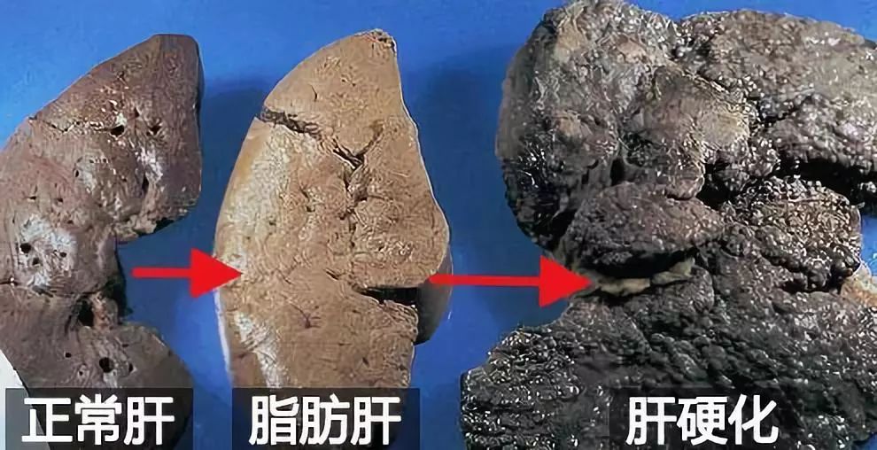 小心肝护肝茶有用吗,小心肝茶叶是什么茶