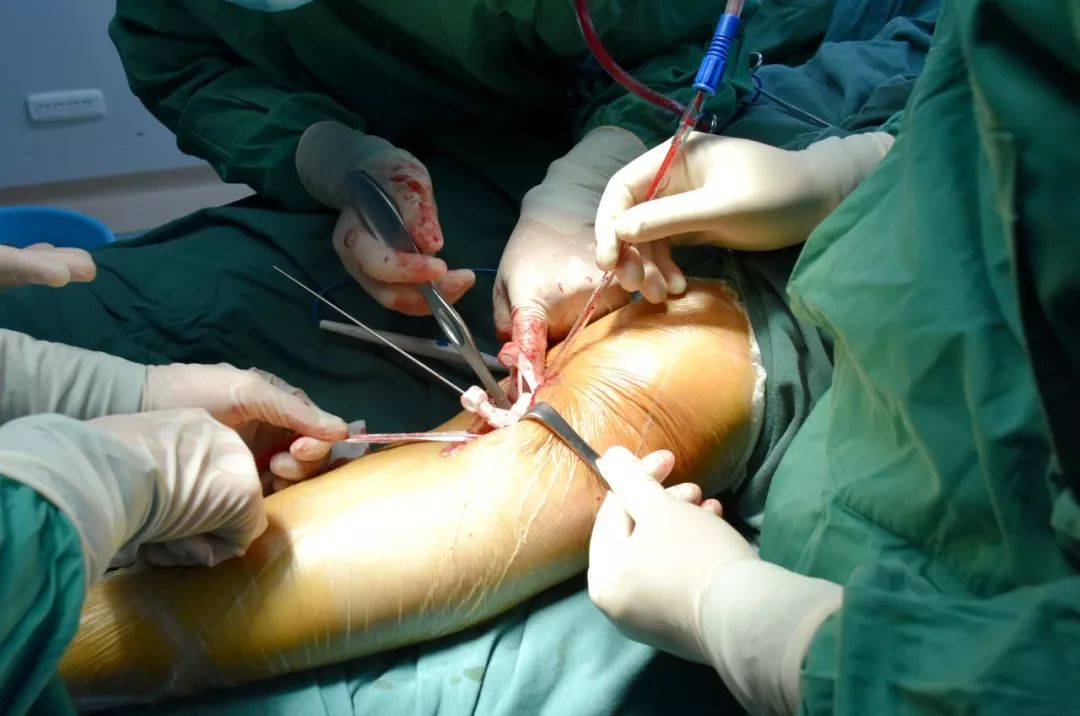 胫骨高位截骨术的适应症,胫骨截骨术hto是微创吗