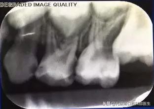 孩子换牙期牙医的四个忠告,口腔医院儿童换牙那些事