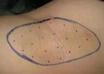 外用涂抹式肉毒素可以祛皱纹吗,去皱纹的肉毒素一年打几次为佳