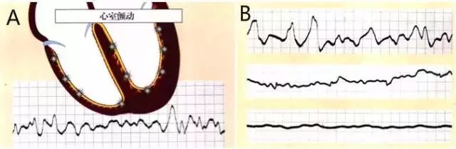 常见心律失常的识别和处理,心衰合并恶性心律失常的治疗策略