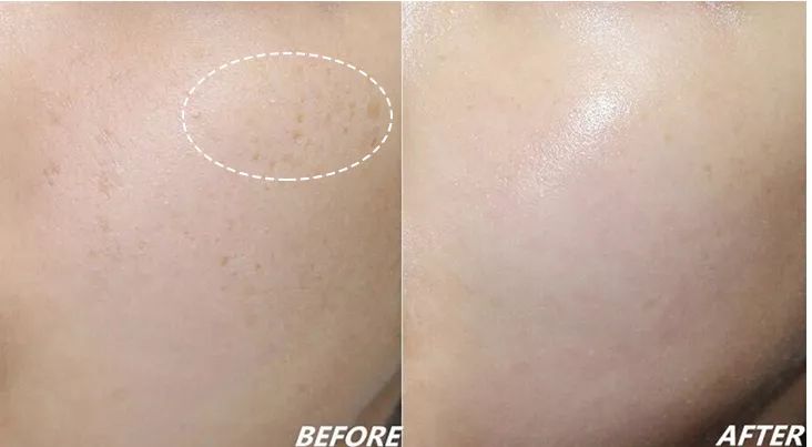 晒斑痘印去除土方法,5个祛斑小妙招淡化晒斑雀斑痘印