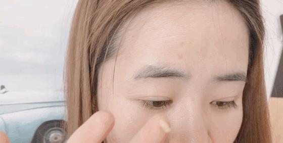 严重痘印晒斑,5个祛斑小妙招淡化晒斑雀斑痘印