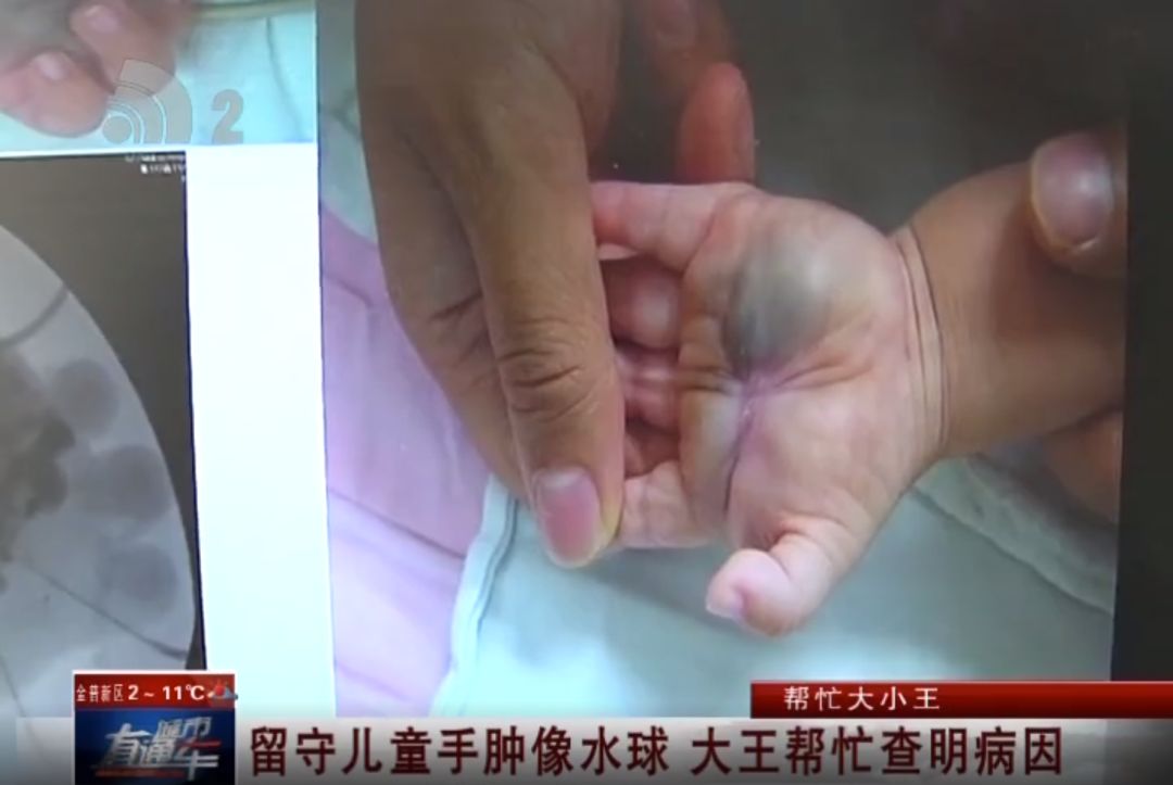 帮忙大小王|留守儿童手肿像水球大王帮忙查明病因