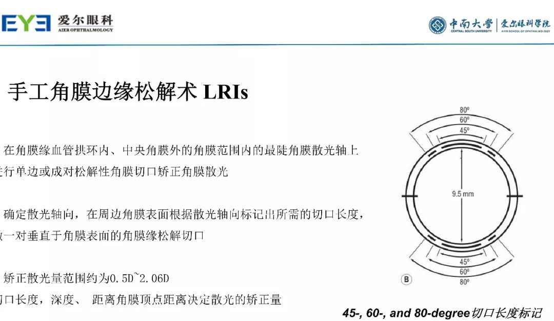 大师讲堂预告丨连续视程白内障手术治疗散光的关键要点-公式选择和手术松解要点