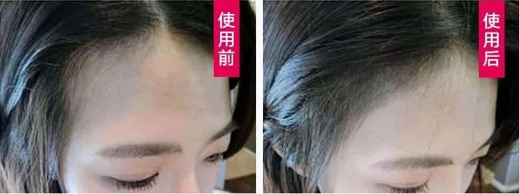 拯救发际线增加发量洗发水,生发发际线的神器测评