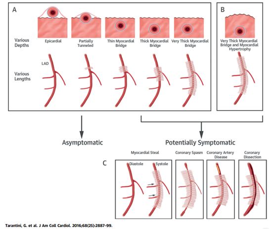 冠脉ct能看到血管粥样硬化,做冠脉ct能看出来心肌缺血吗