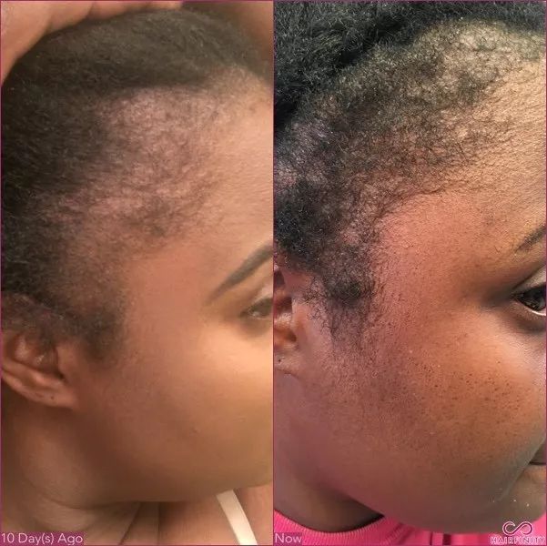 拯救发际线增加发量洗发水,生发发际线的神器测评